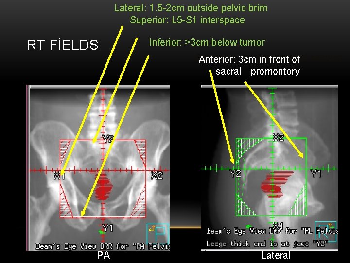 Lateral: 1. 5 -2 cm outside pelvic brim Superior: L 5 -S 1 interspace