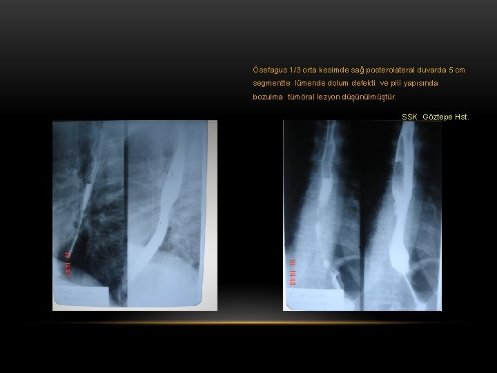 Ösefagus 1/3 orta kesimde sağ posterolateral duvarda 5 cm segmentte lümende dolum defekti ve