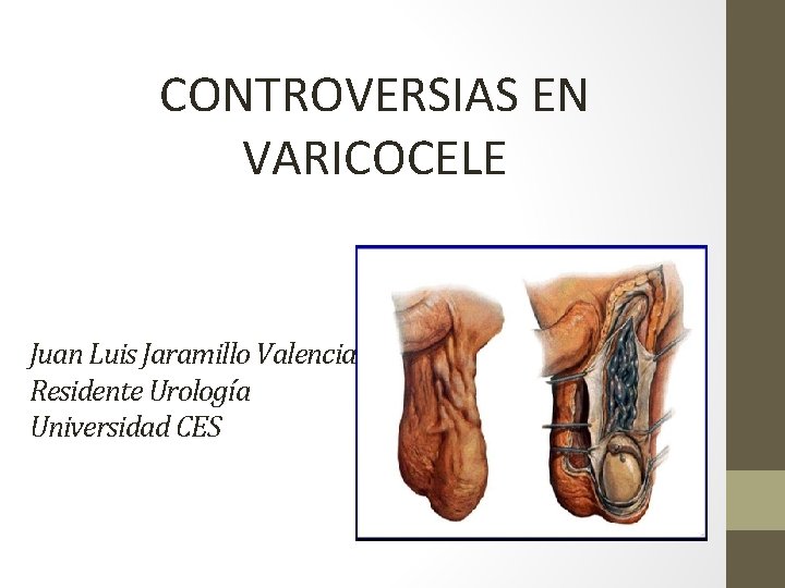 CONTROVERSIAS EN VARICOCELE Juan Luis Jaramillo Valencia Residente Urología Universidad CES 