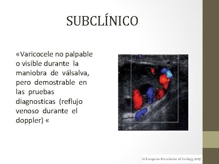 SUBCLÍNICO «Varicocele no palpable o visible durante la maniobra de válsalva, pero demostrable en