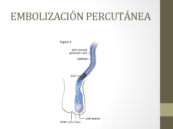 EMBOLIZACIÓN PERCUTÁNEA 