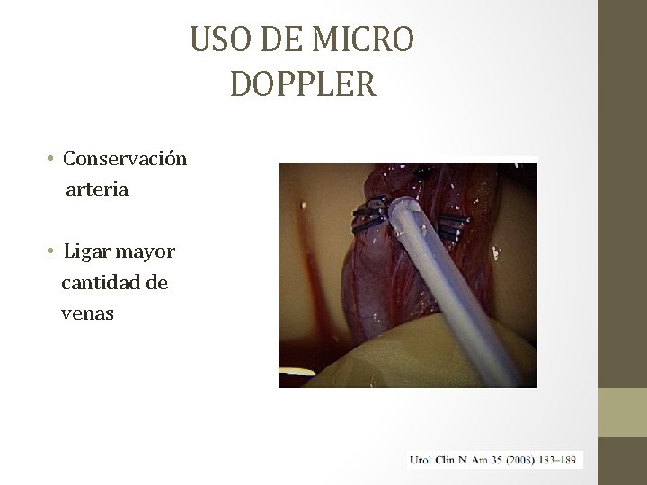 USO DE MICRO DOPPLER • Conservación arteria • Ligar mayor cantidad de venas 