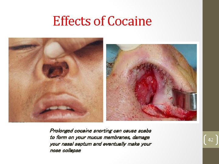 Effects of Cocaine Prolonged cocaine snorting can cause scabs to form on your mucus