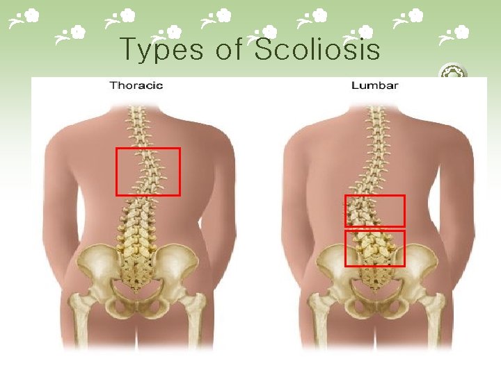 Types of Scoliosis 