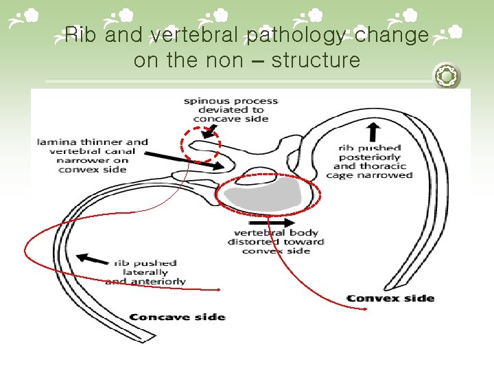 Rib and vertebral pathology change on the non – structure 