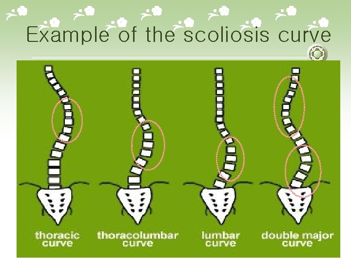 Example of the scoliosis curve 