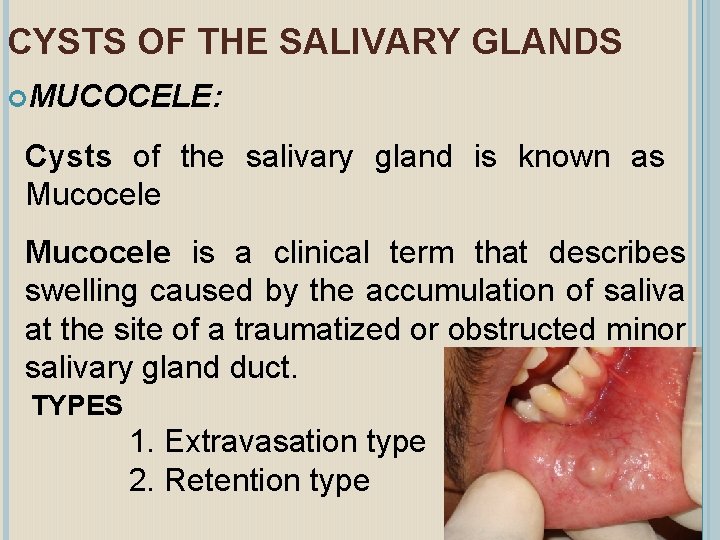 CYSTS OF THE SALIVARY GLANDS MUCOCELE: Cysts of the salivary gland is known as