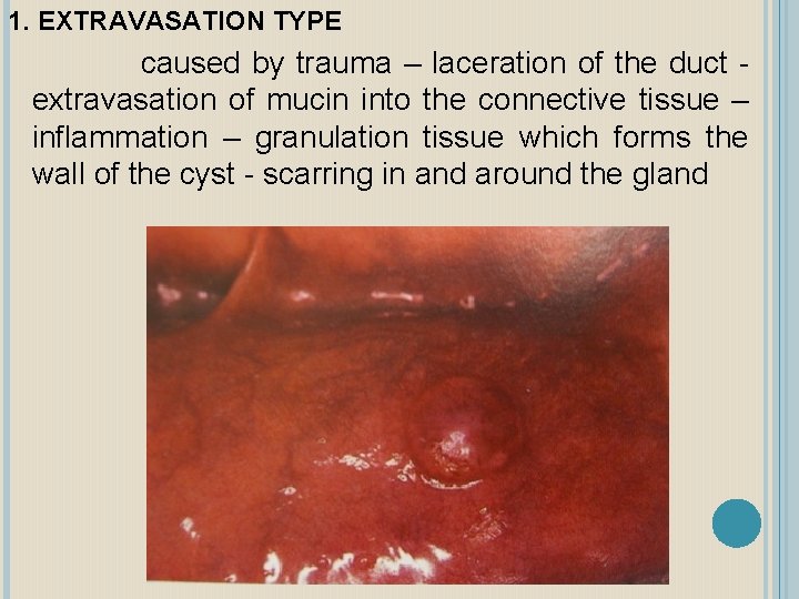 1. EXTRAVASATION TYPE caused by trauma – laceration of the duct extravasation of mucin