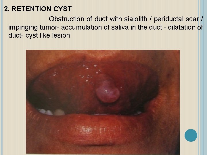2. RETENTION CYST Obstruction of duct with sialolith / periductal scar / impinging tumor-