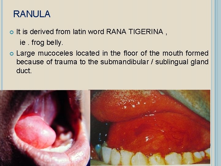 RANULA It is derived from latin word RANA TIGERINA , ie. frog belly. Large