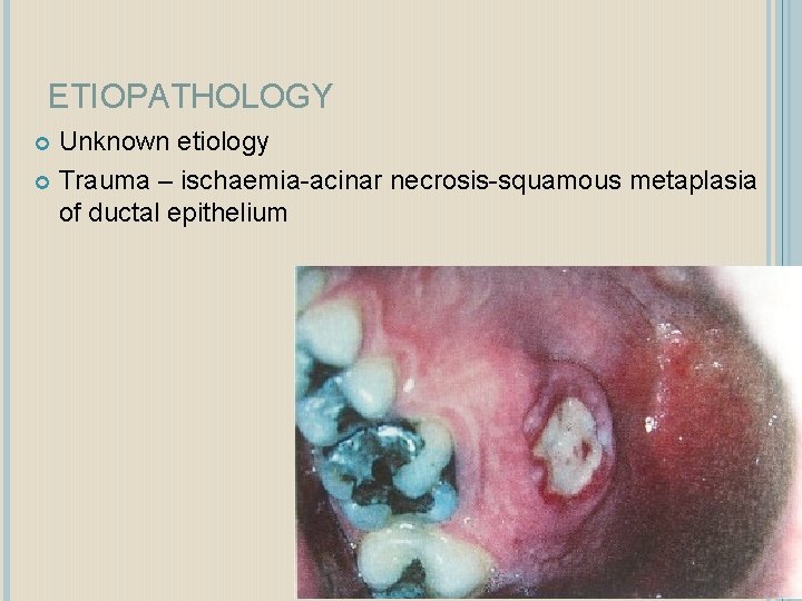 ETIOPATHOLOGY Unknown etiology Trauma – ischaemia-acinar necrosis-squamous metaplasia of ductal epithelium 