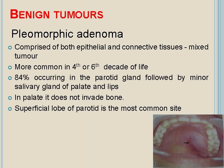BENIGN TUMOURS Pleomorphic adenoma Comprised of both epithelial and connective tissues - mixed tumour