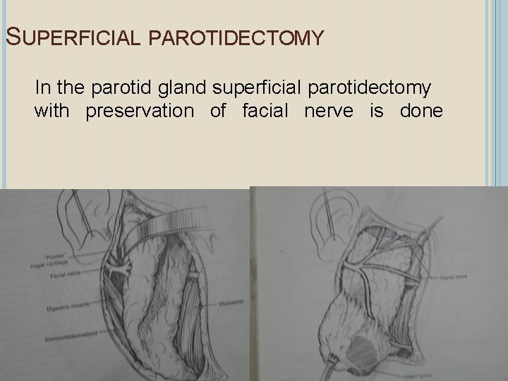 SUPERFICIAL PAROTIDECTOMY In the parotid gland superficial parotidectomy with preservation of facial nerve is