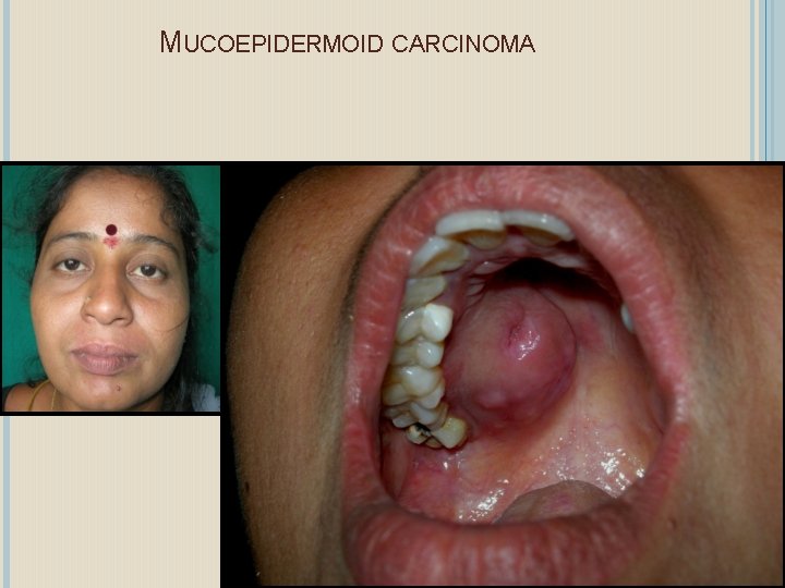 MUCOEPIDERMOID CARCINOMA 