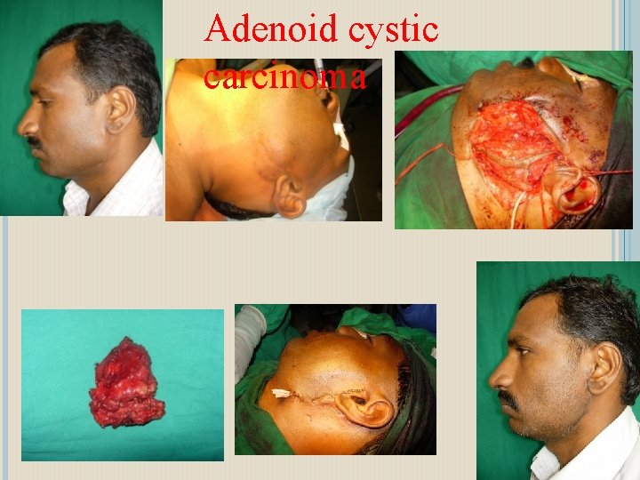Adenoid cystic carcinoma 