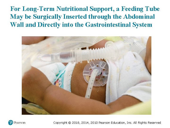 For Long-Term Nutritional Support, a Feeding Tube May be Surgically Inserted through the Abdominal