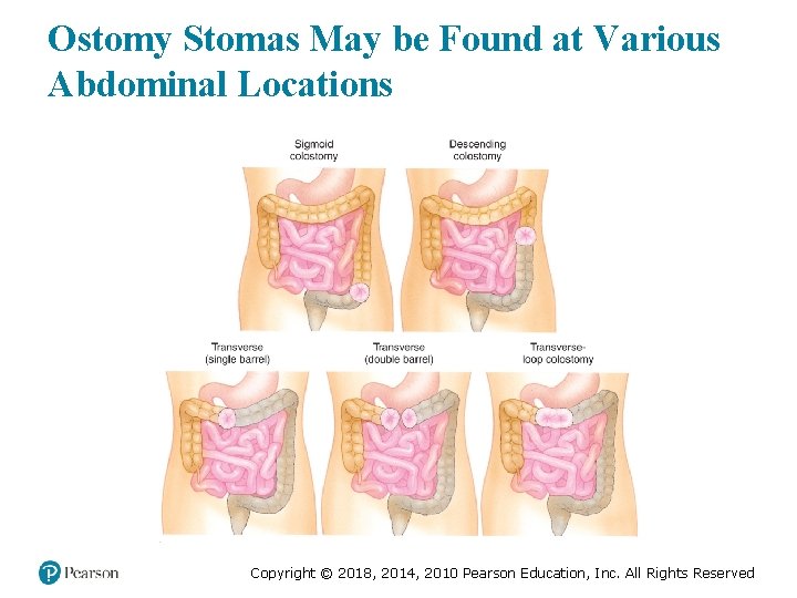 Ostomy Stomas May be Found at Various Abdominal Locations Copyright © 2018, 2014, 2010