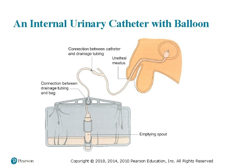 An Internal Urinary Catheter with Balloon Copyright © 2018, 2014, 2010 Pearson Education, Inc.