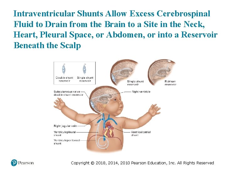 Intraventricular Shunts Allow Excess Cerebrospinal Fluid to Drain from the Brain to a Site