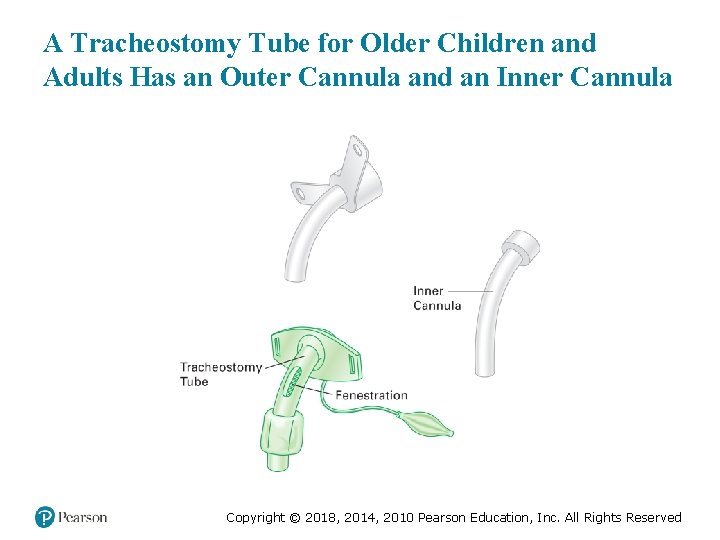 A Tracheostomy Tube for Older Children and Adults Has an Outer Cannula and an