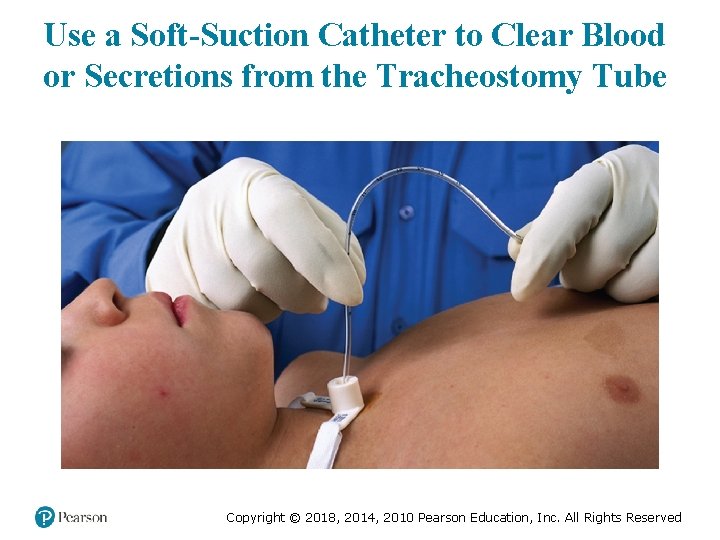 Use a Soft-Suction Catheter to Clear Blood or Secretions from the Tracheostomy Tube Copyright
