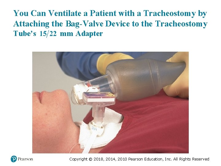 You Can Ventilate a Patient with a Tracheostomy by Attaching the Bag-Valve Device to