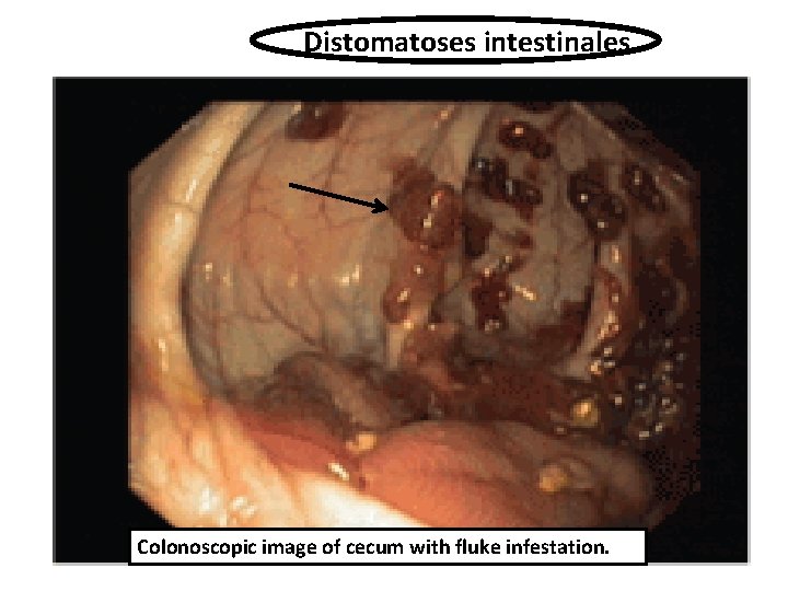 Distomatoses intestinales Colonoscopic image of cecum with fluke infestation. 