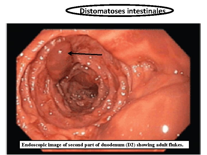 Distomatoses intestinales Endoscopic image of second part of duodenum (D 2) showing adult flukes.
