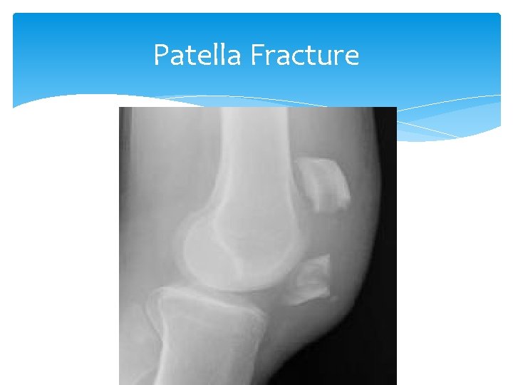 Patella Fracture 