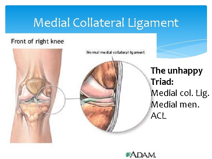 Medial Collateral Ligament The unhappy Triad: Medial col. Lig. Medial men. ACL 