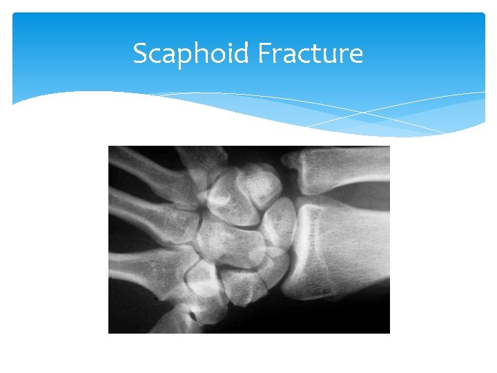 Scaphoid Fracture 