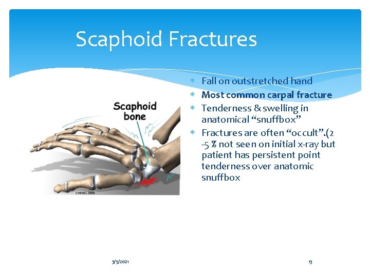 Scaphoid Fractures Fall on outstretched hand Most common carpal fracture Tenderness & swelling in