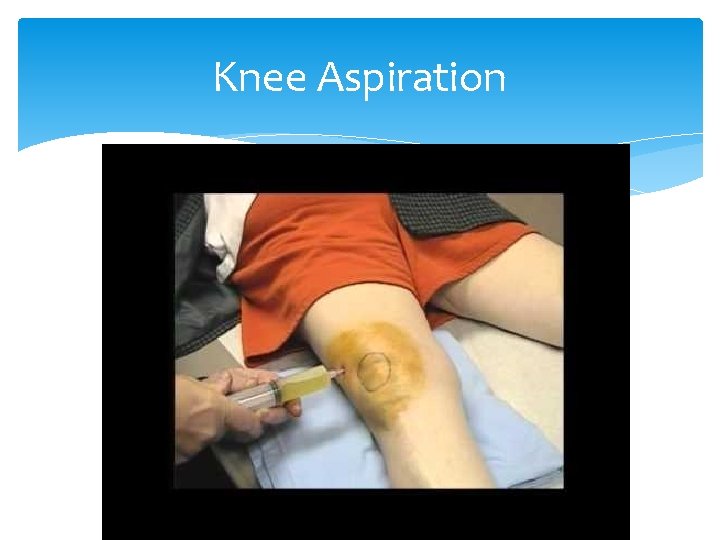 Knee Aspiration 