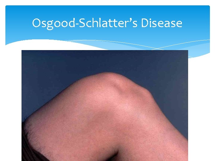 Osgood-Schlatter’s Disease 