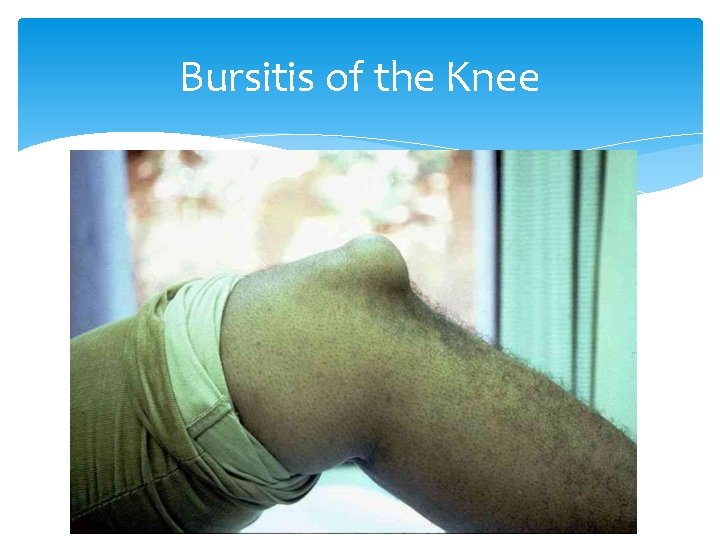 Bursitis of the Knee 