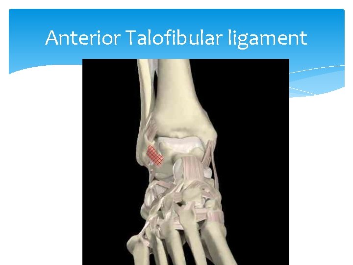 Anterior Talofibular ligament 