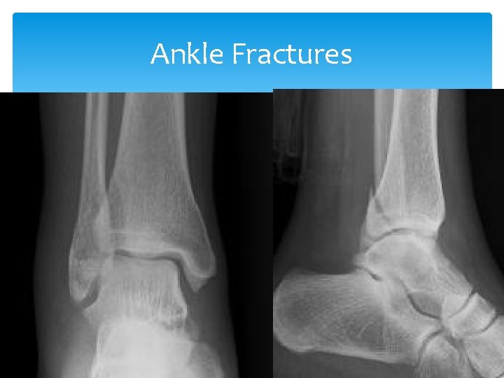 Ankle Fractures 