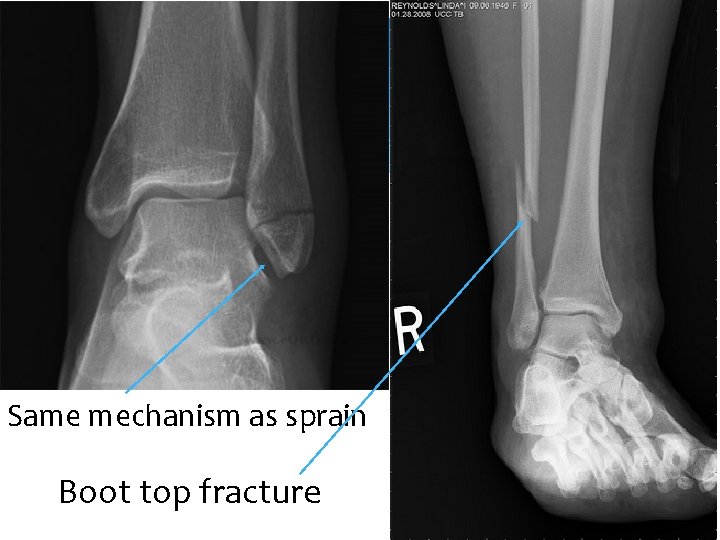 Same mechanism as sprain Boot top fracture 