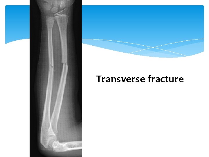 Transverse fracture Fracture 