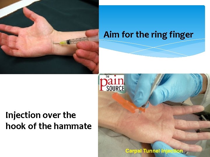 Aim for the ring finger Injection over the hook of the hammate 