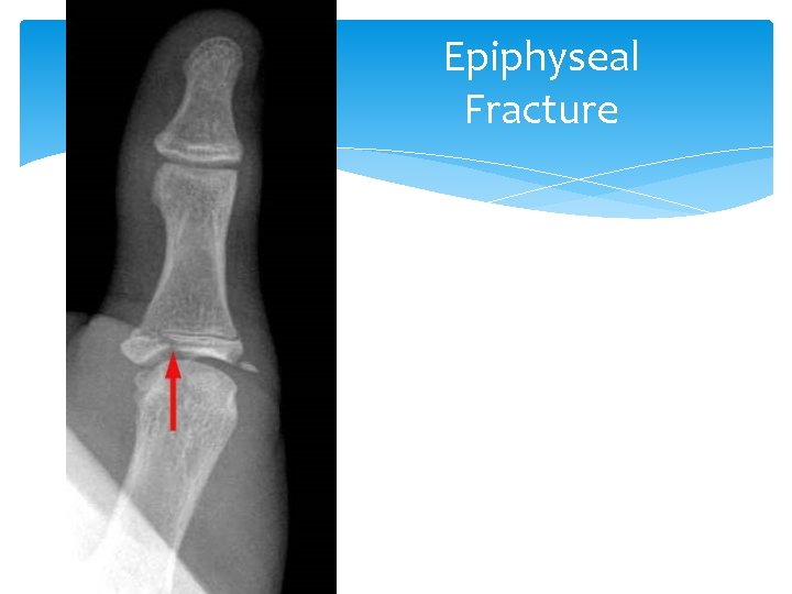 Epiphyseal Fracture 