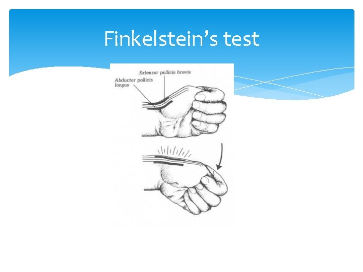 Finkelstein’s test 