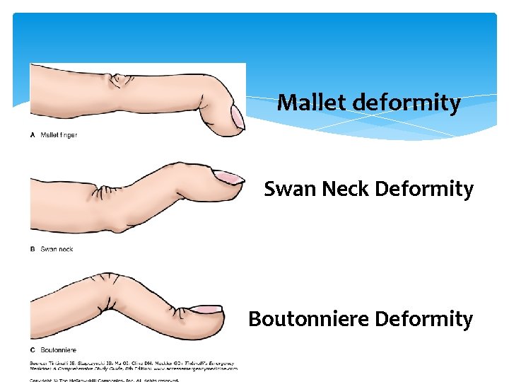 Mallet deformity Swan Neck Deformity Boutonniere Deformity 