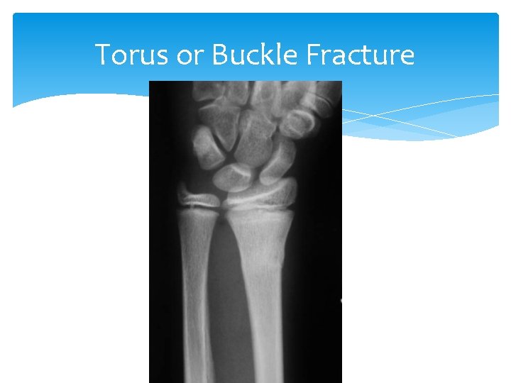 Torus or Buckle Fracture 