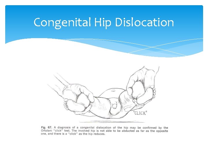 Congenital Hip Dislocation 
