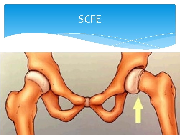 SCFE Adolescent, ball of femur slips backwards, weakness of growth plate 