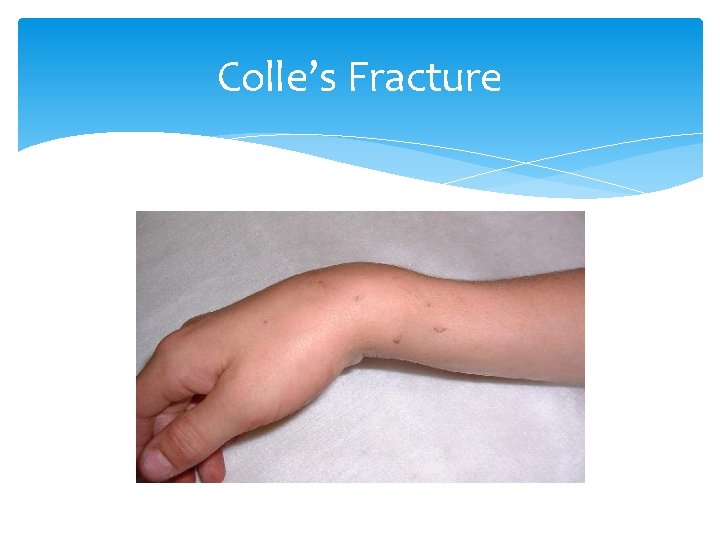 Colle’s Fracture 