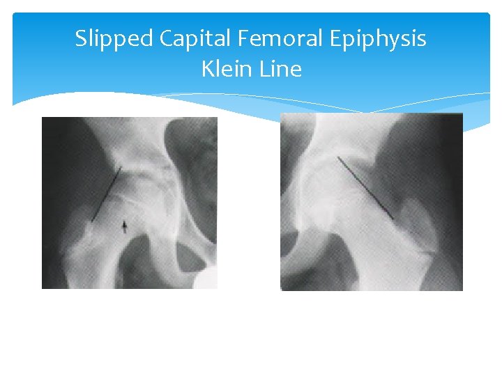 Slipped Capital Femoral Epiphysis Klein Line 