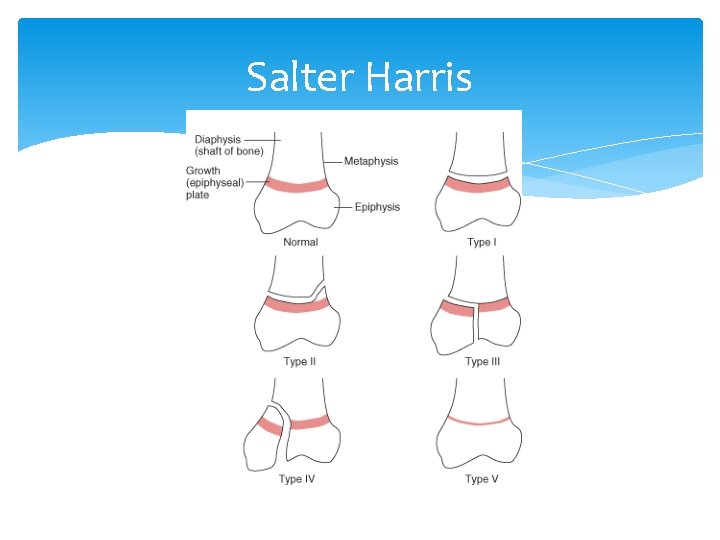 Salter Harris 