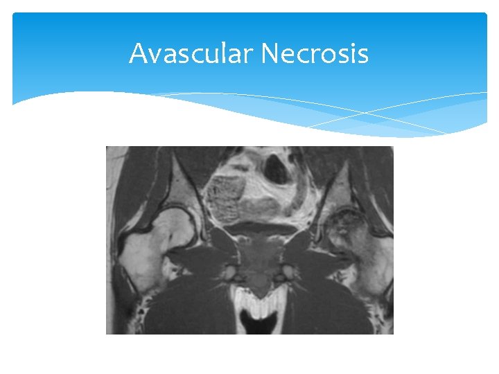 Avascular Necrosis 